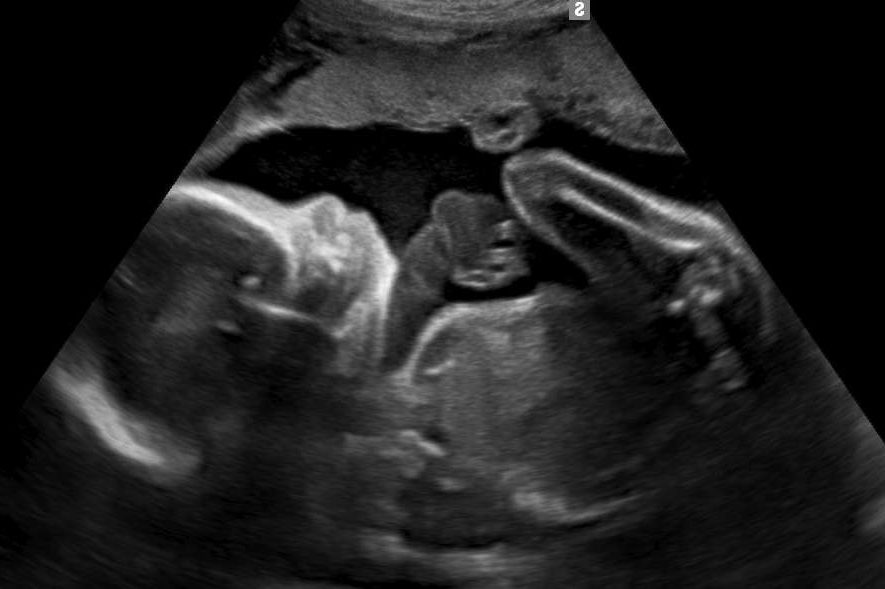 Black-and-white 2D ultrasound scan
