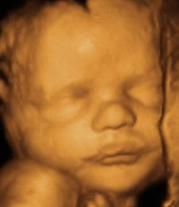 Lifelike 3D ultrasound rendering of a baby's face